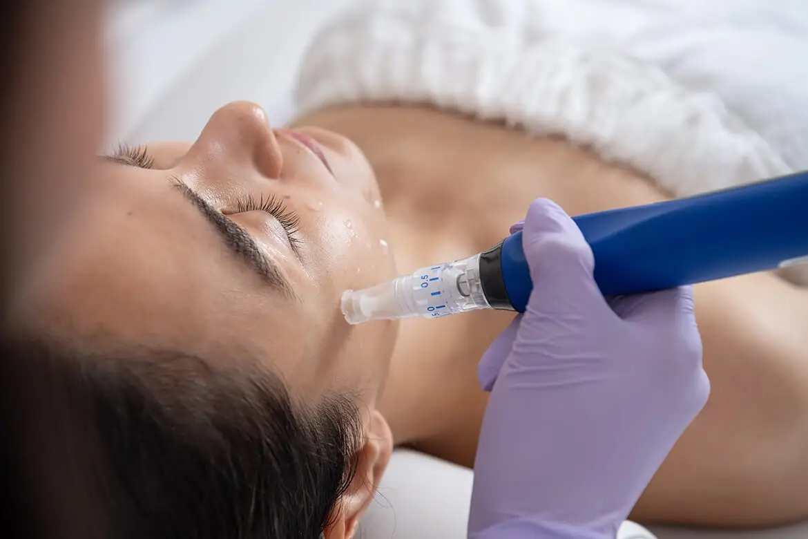What To Expect From Microneedling in Lehi, UT | Avanti Medical Center
