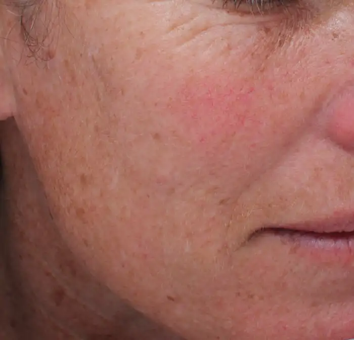 Avanti-medical-center-moxi treatments before In Lehi UT