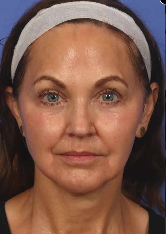After Treatment Photo of Radiofrequency (RF) Microneedling in Lehi, UT | Avanti Medical Center