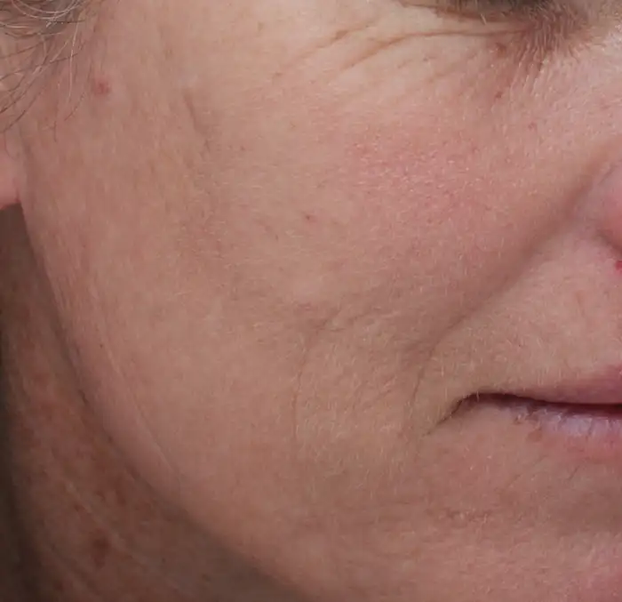 Moxi Tretaments After Results - Avanti Medical Center in Lehi, UT