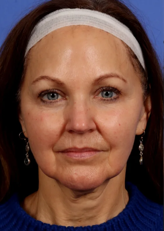 Before Treatment Photo of Radiofrequency (RF) Microneedling in Lehi, UT | Avanti Medical Center Before Treatment Photo of Radiofrequency (RF) Microneedling in Lehi, UT | Avanti Medical Center